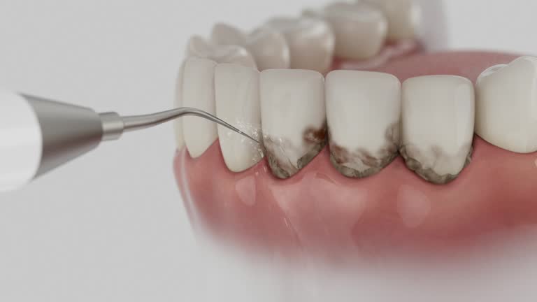 Trusted Wisdom Tooth Removal service in Compton, CA - Dentist Open Now